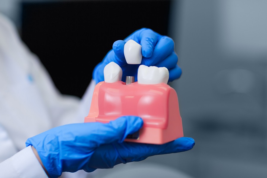 Dental Implants Are a Solution to Replacing Lost Teeth
