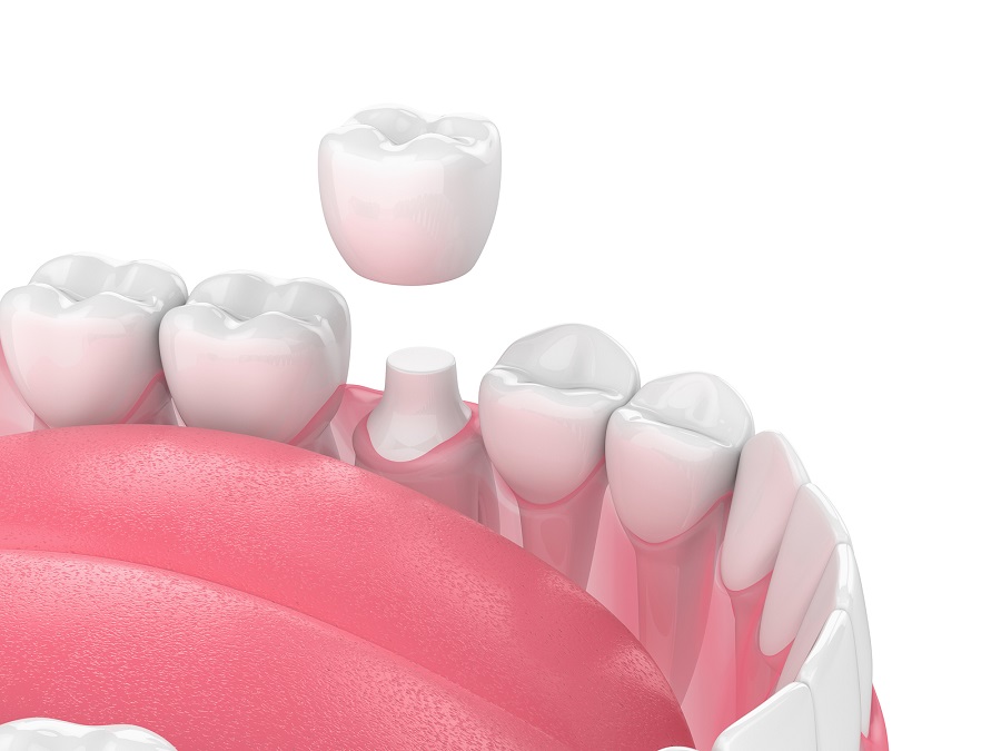 A Dental Crown Can Beautifully Restore Your Tooth